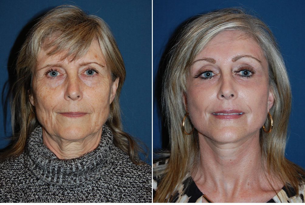Facial plastic surgery in Charlotte NC:  Benefits of a neck lift
