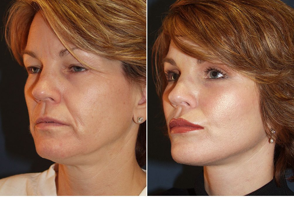 Lip enhancement by Charlotte’s best facial plastic surgeon