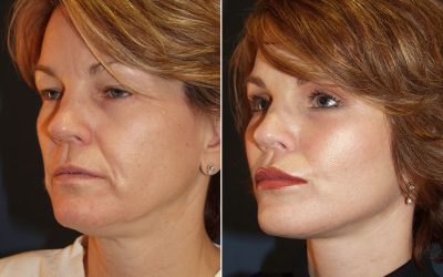 Best Charlotte facial plastic surgeon available at Only Faces of Charlotte