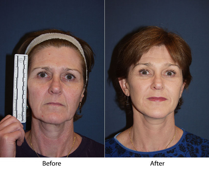 Brow Lift and Forehead Lift Surgery in Charlotte