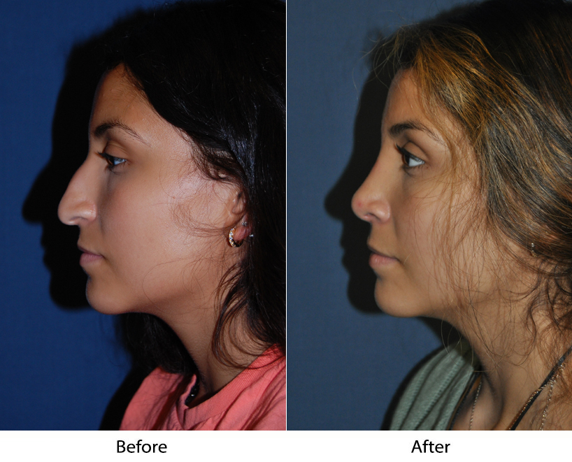 Nose job surgeon in Charlotte NC offers dorsal hump removal