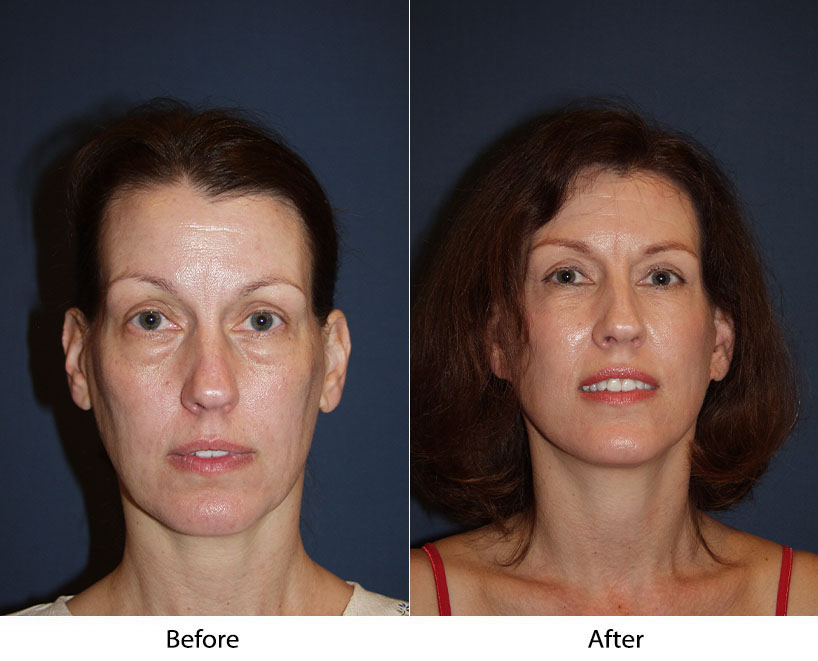 Get an eyelift in Charlotte from the top facial plastic surgeon