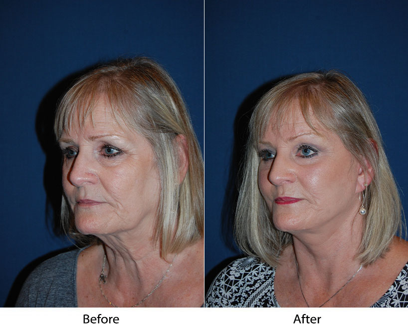 Eye lift in Charlotte, NC with the best facelift surgeon