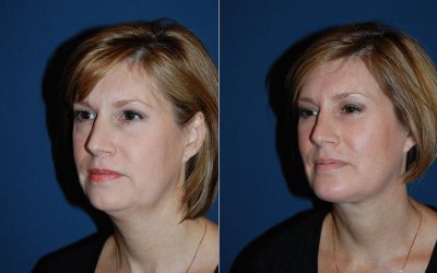 Top facial plastic surgeon in Charlotte NC: Why have a facelift and neck lift together