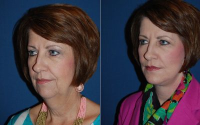 Facelifts — great skill, great improvement