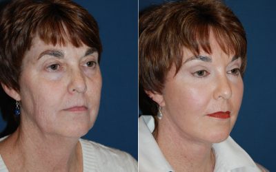 Deep Plane Facelift procedure in Charlotte NC when you are ready