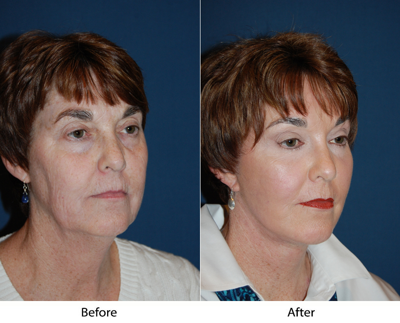 Deep Plane Facelift procedure in Charlotte NC when you are ready