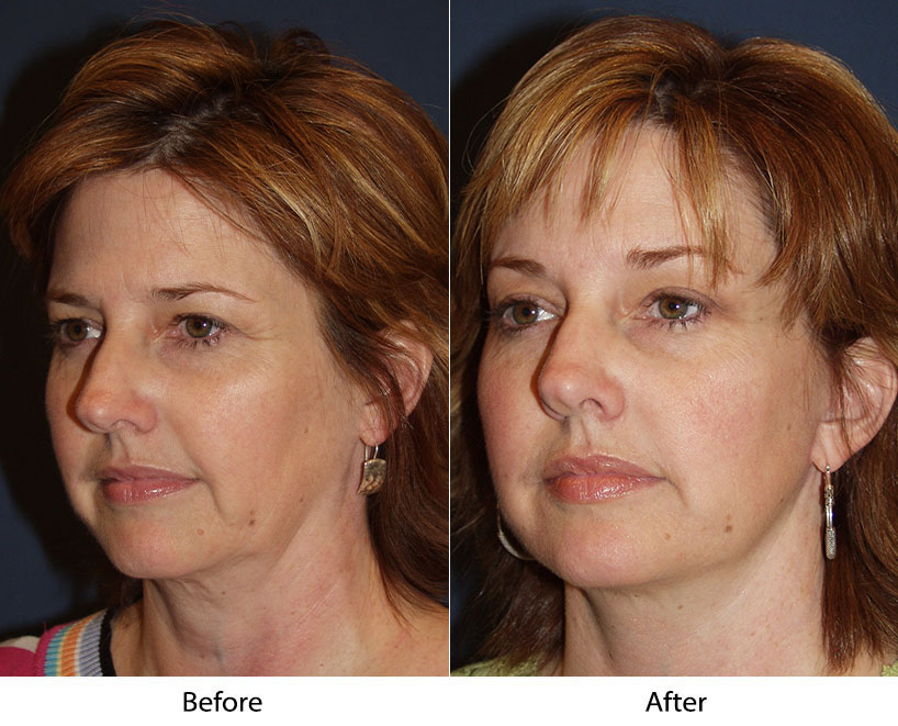 Best facial plastic surgeon and surgeries performed in Charlotte, NC.