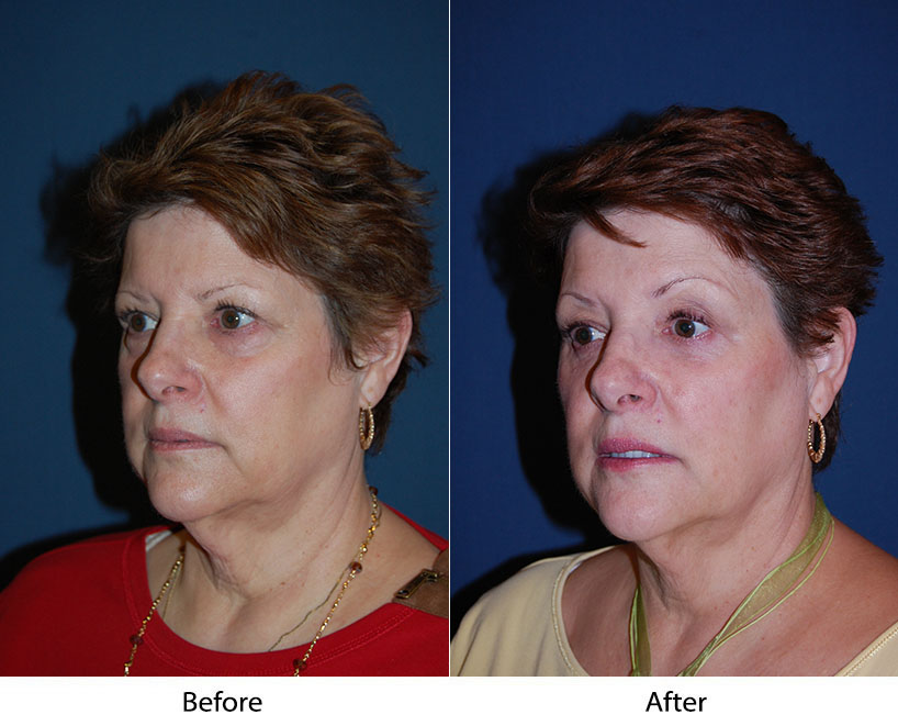 Lower eye lid surgery in Charlotte NC: What to know about a blepharoplasty procedure