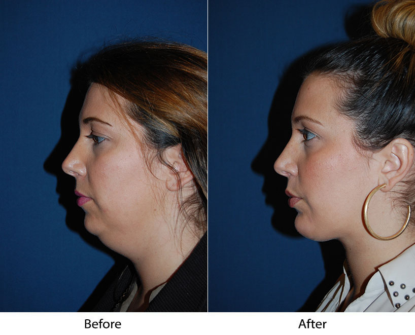 Top facial plastic surgeon in Charlotte NC: Neck Lift 101