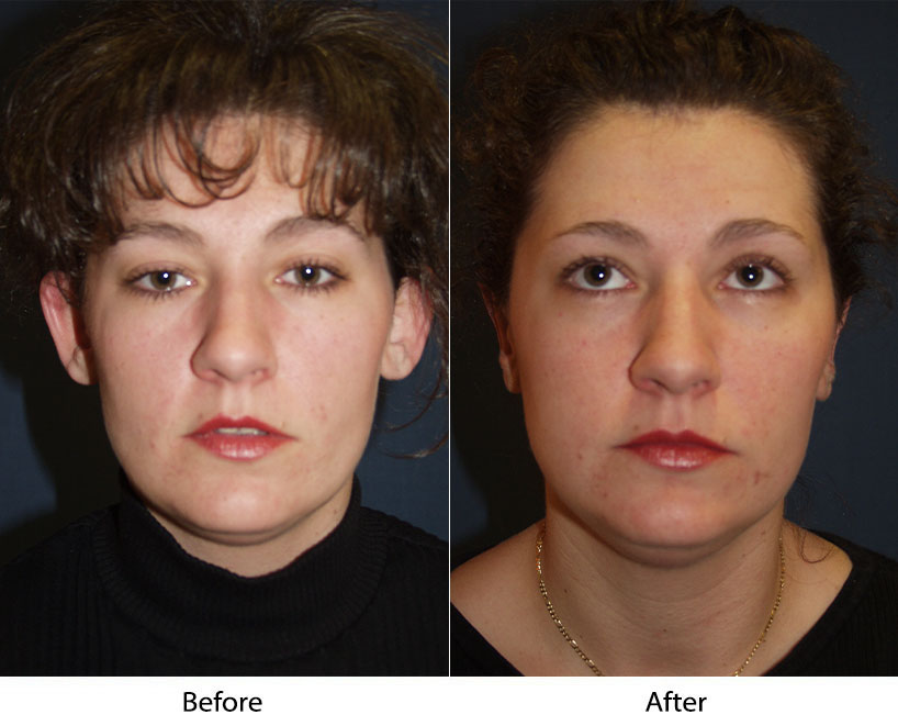 Facial plastic surgeon to do an otoplasty on your ears in Charlotte