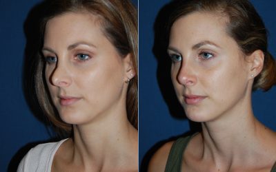 Understanding revision rhinoplasty in Charlotte NC: Call the top nose surgeon