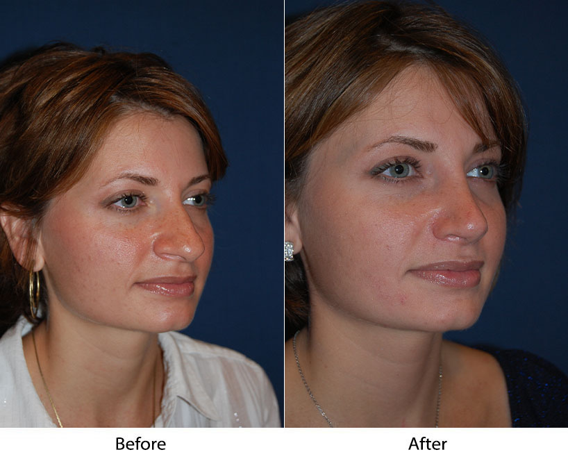 Can a rhinoplasty surgeon do more in Charlotte NC?