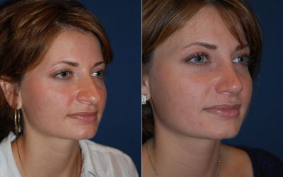 Best Charlotte Rhinoplasty surgeon, Dr. Sean Freeman of Only Faces, creates harmony and balance for faces