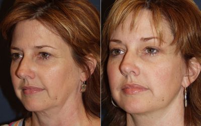 Charlotte’s best facial plastic surgeon explains why deep plane facelift is a great approach