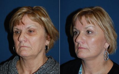 Lower lid “SOOF” lift blepharoplasty expert in Charlotte answers questions