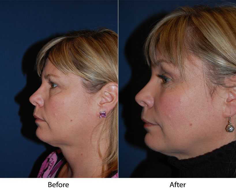 Brow lift surgery expert in Charlotte NC explains the different facial plastic surgeries
