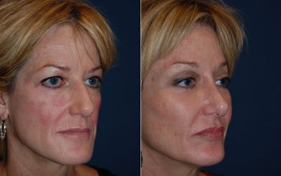 Endoscopic brow lift in Charlotte NC vs. traditional with top Charlotte facial plastic surgeon