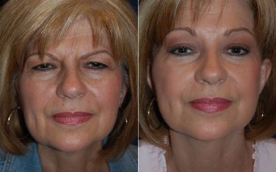 Best brow lift from best facial plastic surgeon in Charlotte NC: benefits to consider