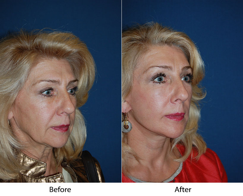 Facial plastic surgery in Charlotte NC debunks chin implant myths