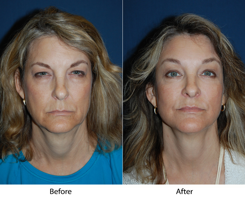 Eye lid surgery in Charlotte NC: surgery vs. Fillers: Top facial plastic surgeon