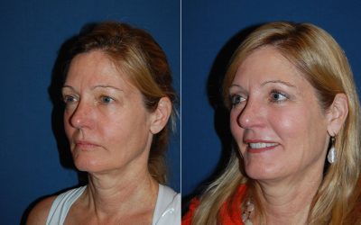 Can a Charlotte NC facial plastic surgeon do eyelifts?
