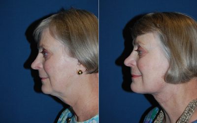 Top facial plastic surgery in Charlotte, NC: how to prepare for a facelift