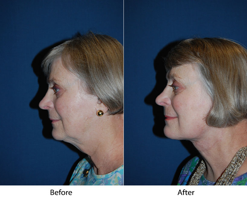 Top facial plastic surgery in Charlotte, NC: how to prepare for a facelift