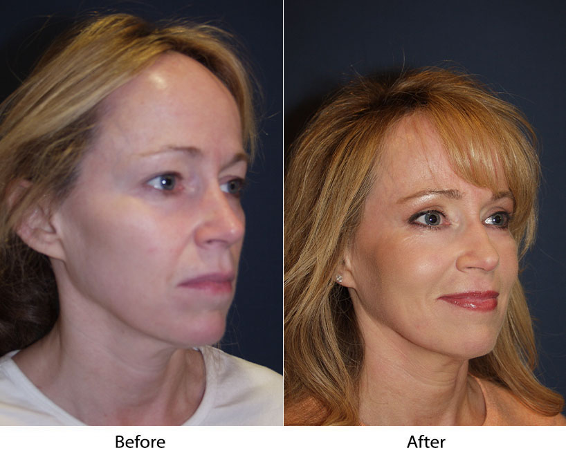 Best facelift specialist in Charlotte, NC helps correct surgeries