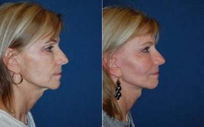 Best facial plastic surgeon in Charlotte NC: How implants improve facial deficiencies
