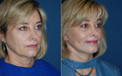 Facelift procedure of the lower part of the face: Top Charlotte facial plastic surgeon
