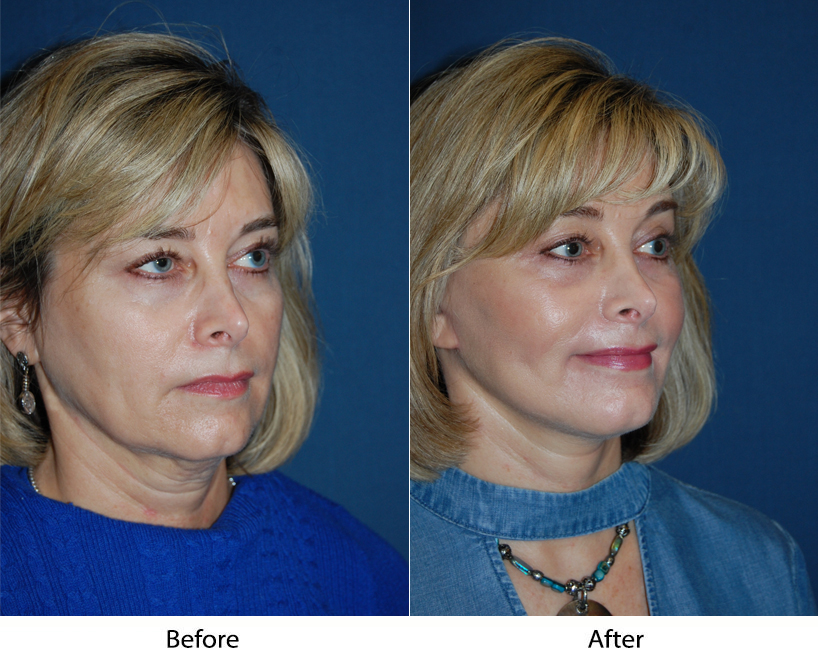 Facelift procedure of the lower part of the face: Top Charlotte facial plastic surgeon