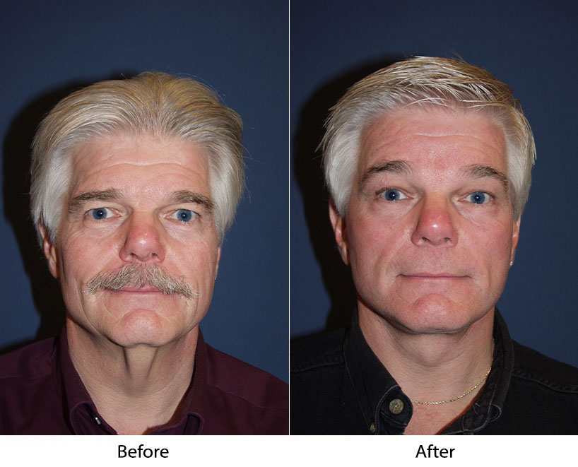 Facial plastic surgery in Charlotte NC offers tips for men having plastic surgery