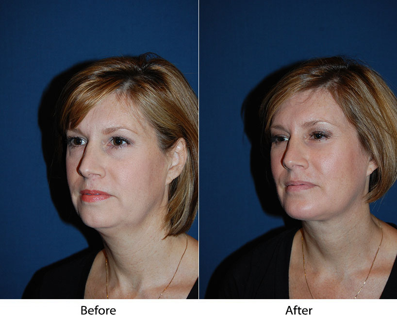 Top facial plastic surgeon in Charlotte, NC explains neck lift recovery