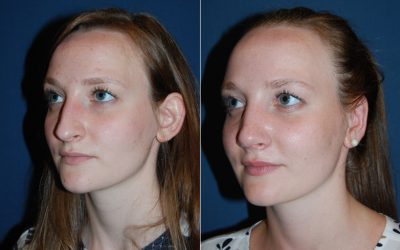 Facial plastic surgeon to do an otoplasty on your ears in Charlotte