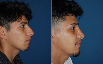 Rhinoplasty: what to expect from the top nose job surgeon in Charlotte