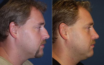 Rhinoplasty surgery in Charlotte NC to change your nose