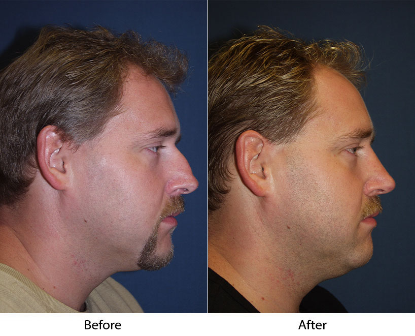 Rhinoplasty surgery in Charlotte NC to change your nose