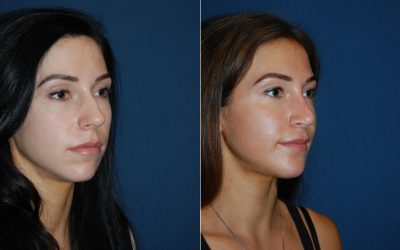 Top rhinoplasty Specialist in Charlotte, NC, and preparation