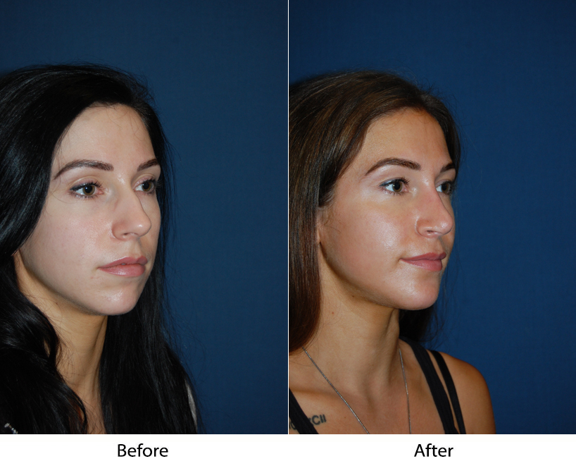 Top rhinoplasty Specialist in Charlotte, NC, and preparation