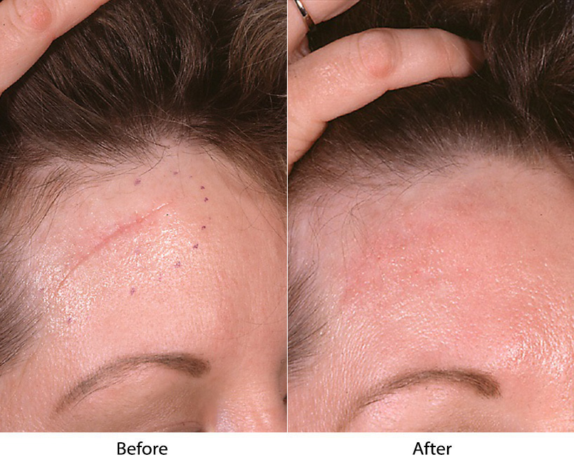Top facial plastic surgeon in Charlotte NC offers scar revision