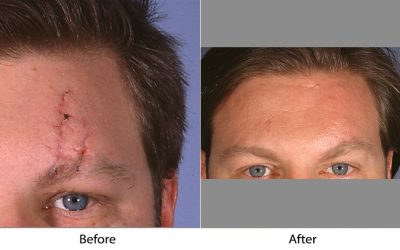 Facial plastic surgery in Charlotte NC can reduce the different types of scars