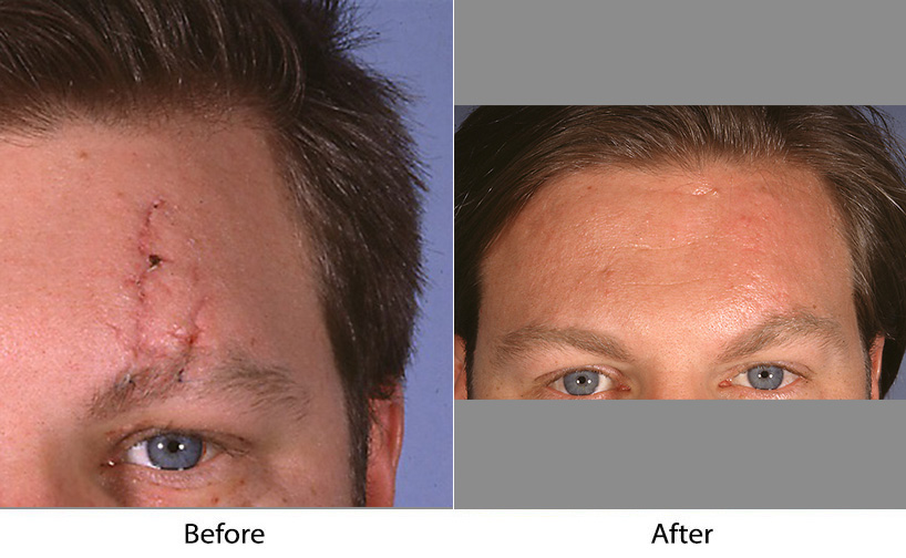Facial plastic surgery in Charlotte NC can reduce the different types of scars