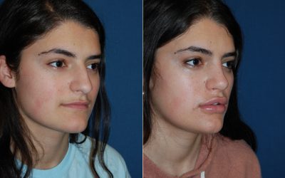 Teen rhinoplasty surgeons in Charlotte offer the pros of nose surgery
