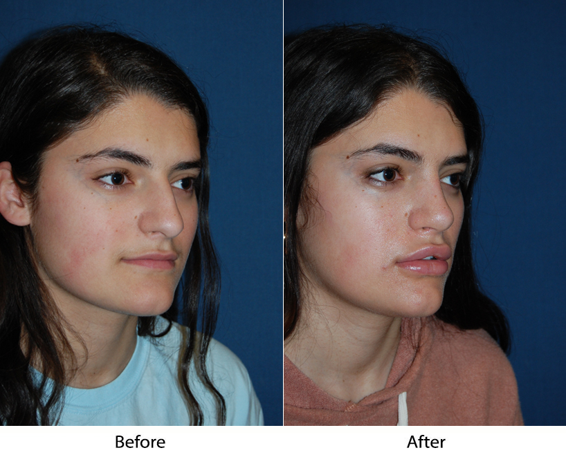 Teen rhinoplasty surgeons in Charlotte offer the pros of nose surgery
