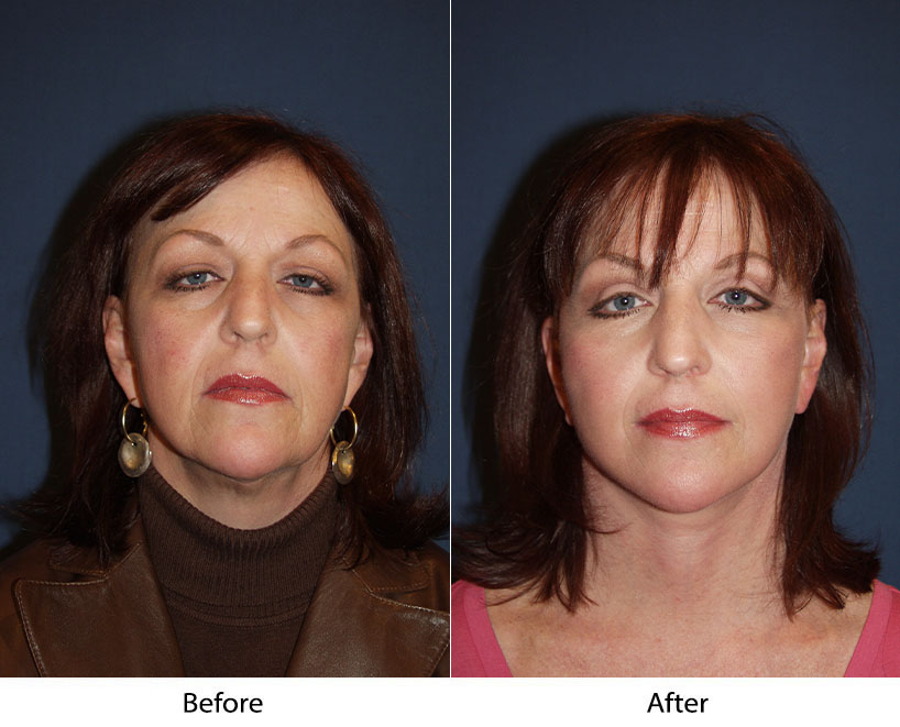 Charlotte’s top facelift experts explain exercising after a procedure for athletes