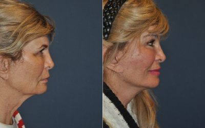 Charlotte’s best facial plastic surgeon explains facial care after a facelift