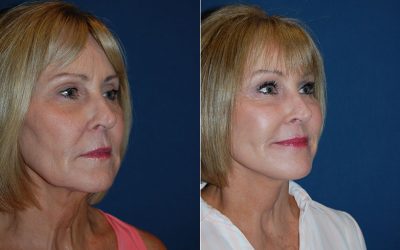 Brow lift surgery expert in Charlotte NC explains the facial plastic surgical costs