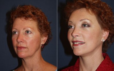 Best eyelift surgeon in Charlotte NC explains what to expect with blepharoplasty