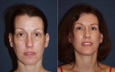 Charlotte’s best eyelift surgeon explains the costs of the upper and lower eyelid surgery